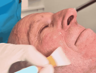 Reveal Your Radiance – Microdermabrasion, Cosmetic Clinic Invercargill